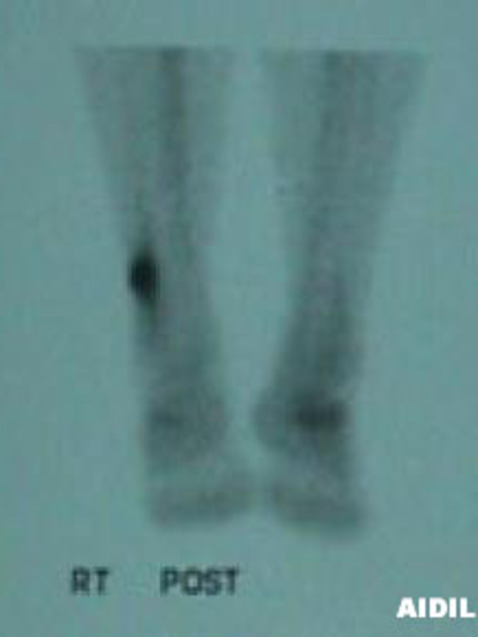 Posterior View of Bone Scan of Fibula Stress Fracture