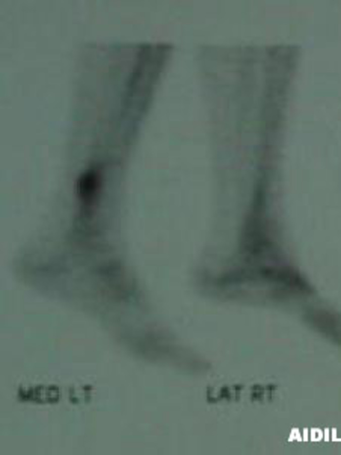 Lateral Right/Medial Left View of Bone Scan of Fibula Stress Fracture