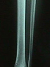AP View of X-Ray of Fibula Stress Fracture