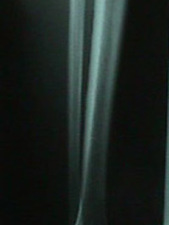 Lateral View of X-Ray of Fibula Stress Fracture