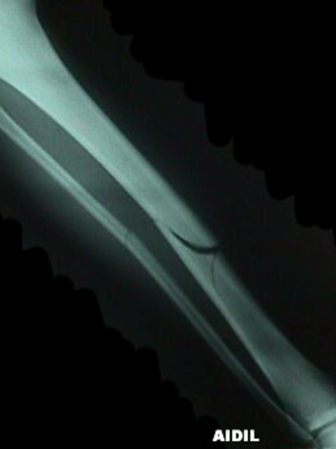 AP View of Oblique Tibia / Fibula Fracture