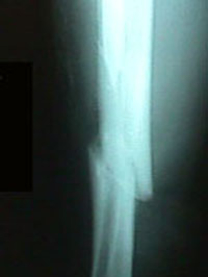 Lateral View of Tibia/Fibula Fracture