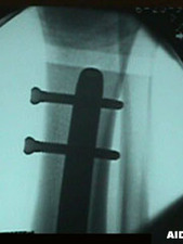 AP View of Tibia/Fibula Fracture After Repair 