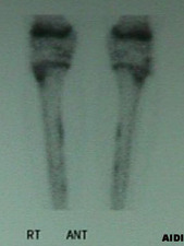 AP View of Bone Scan of Posterior Tibialis Periostitis