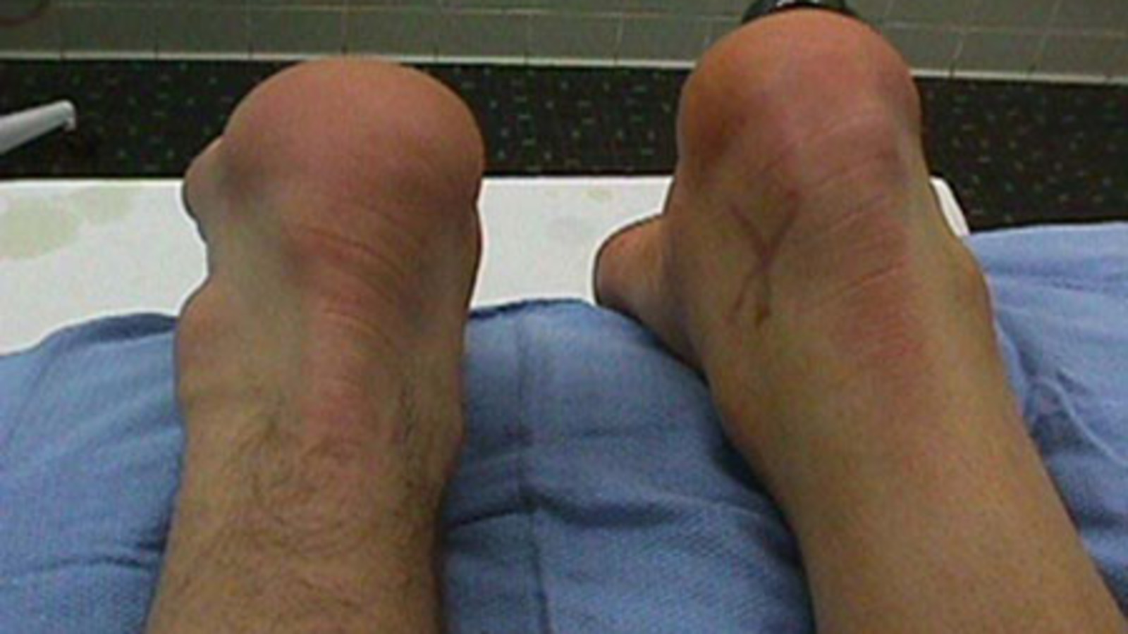 Ruptured Achilles Tendon Prior to Surgery