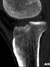 Bone Scan of Tibial Plateau Fracture