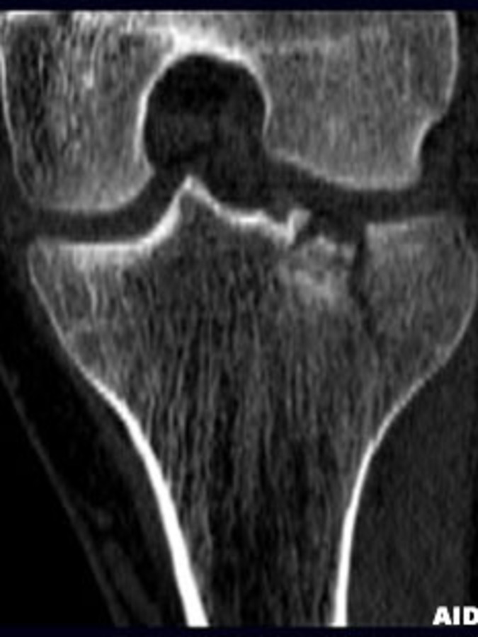 Bone Scan of Tibial Plateau Fracture