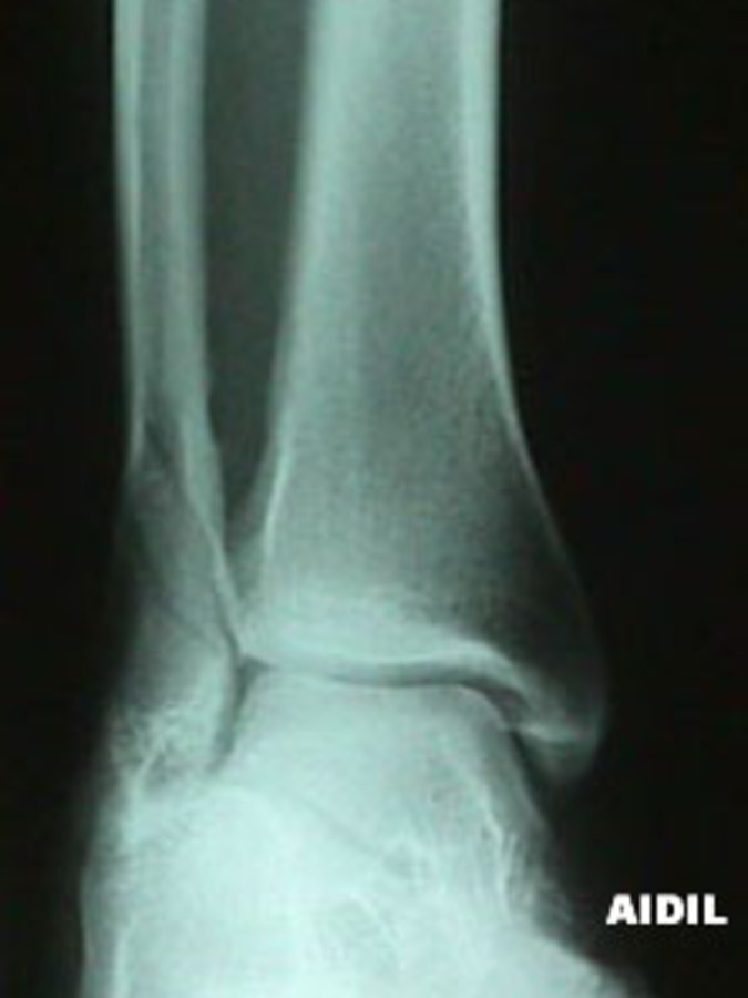 Mortise View of Fibula Fracture