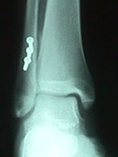 Mortise View of Fibula Fracture