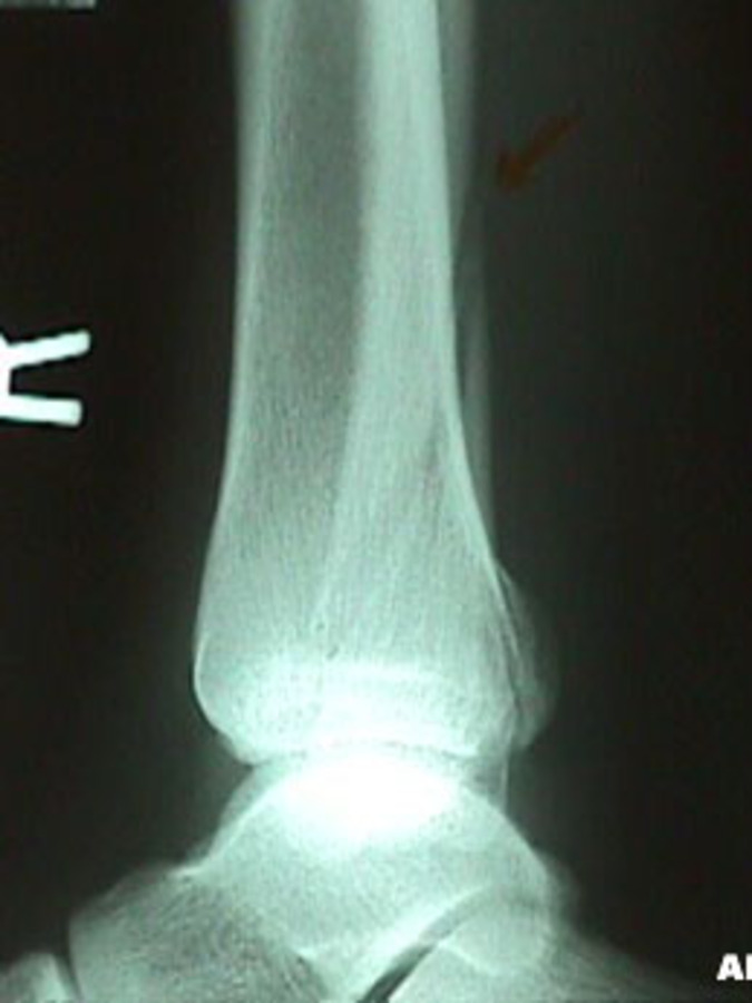 Lateral View of Fibula Fracture