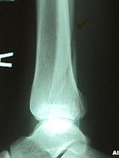 Lateral View of Fibula Fracture
