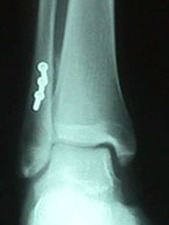 Mortise View of Fibula Fracture After Repair