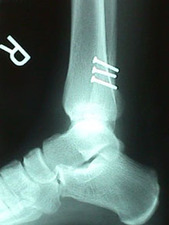 Lateral View of Fibula Fracture After Repair