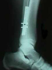 Lateral View of Fibula Fracture Repair with Plate
