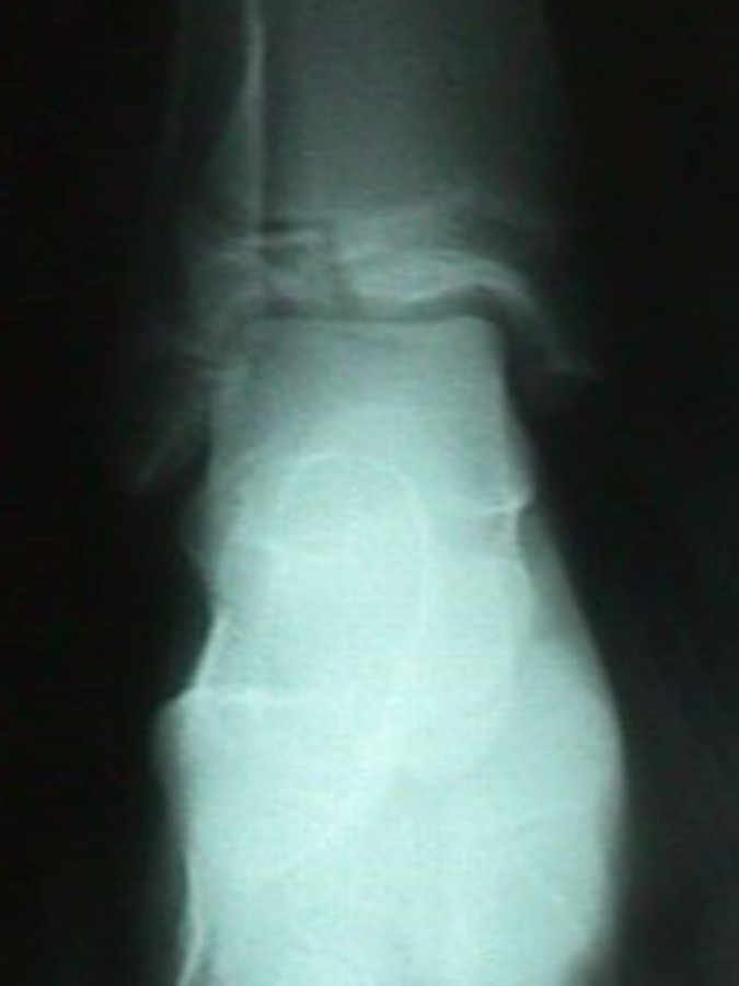 AP View of Epiphyseal Tibial Fracture - Salter-Harris Classification III