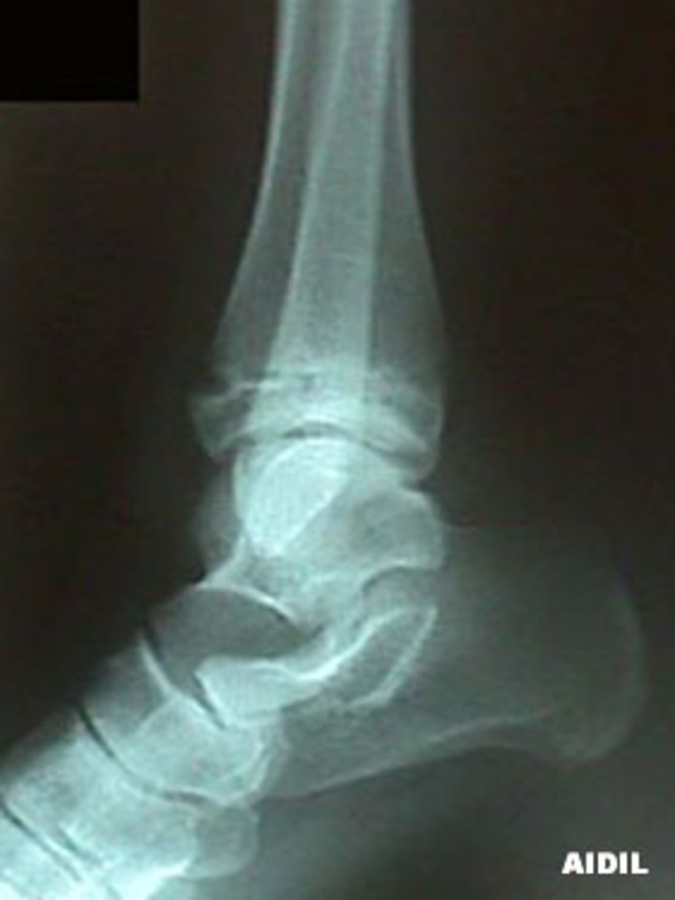 Lateral View of Epiphyseal Tibial Fracture - Salter-Harris Classification III