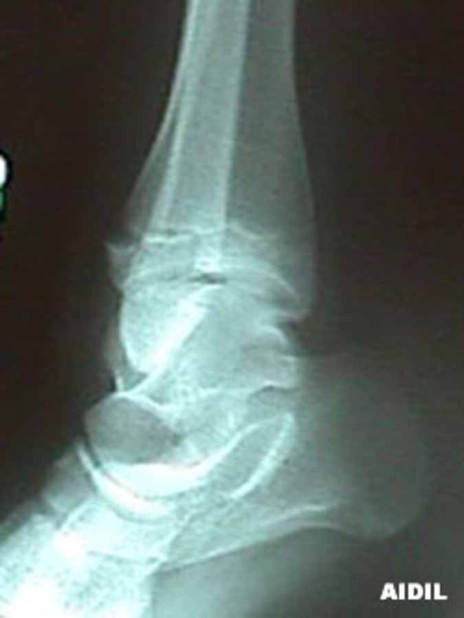 External Rotation of Epiphyseal Tibial Fracture - Salter-Harris Classification III