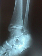 Mortise View of Epiphyseal Tibial Fracture - Salter-Harris Classification III