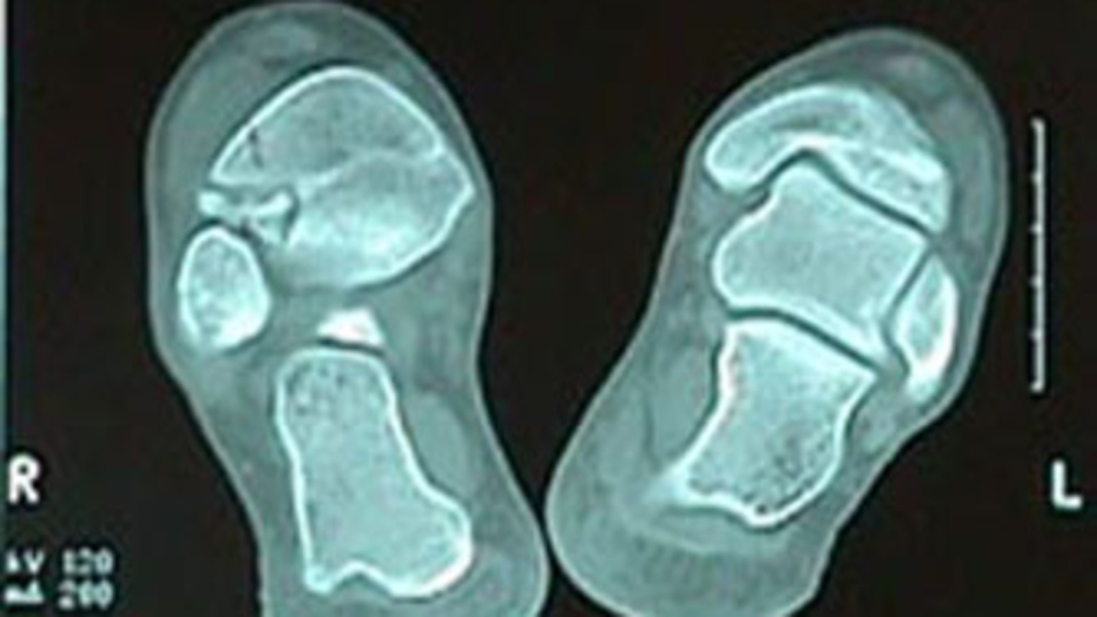 CAT Scan of Epiphyseal Tibial Fracture - Salter-Harris Classification III
