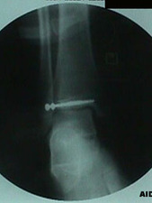 AP View Epiphyseal Tibial Fracture - Salter-Harris Classification III After Repair