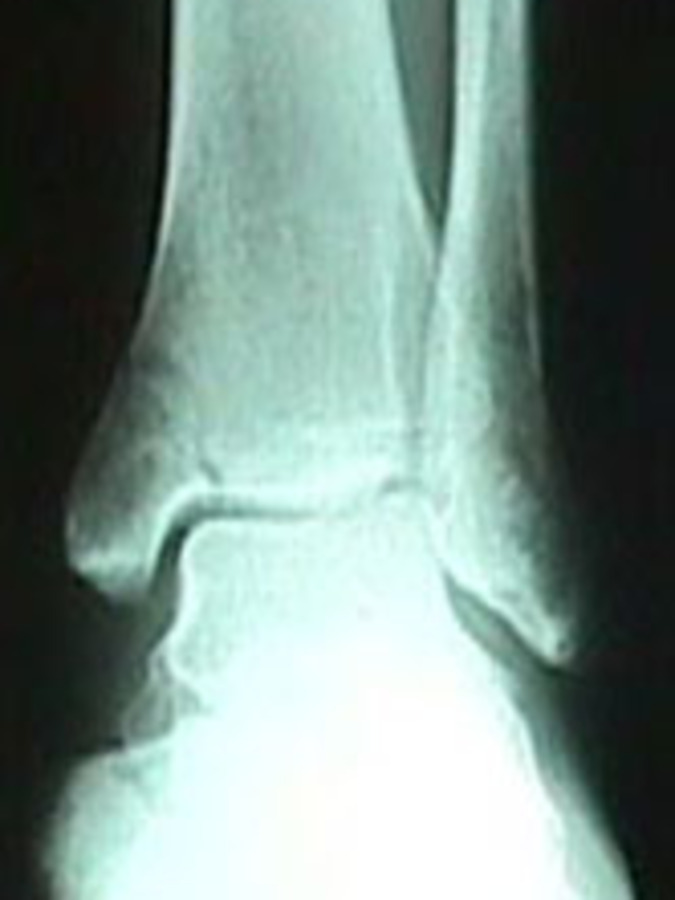 AP View of Tibia Fracture