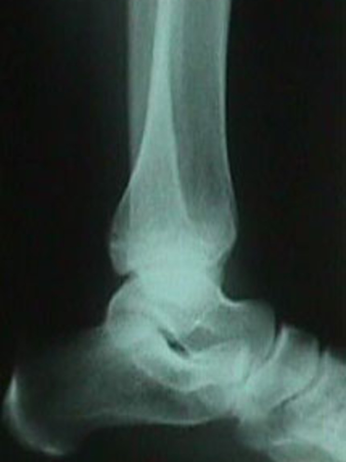 Lateral View of Tibia Fracture
