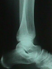 Lateral View of Tibia Fracture