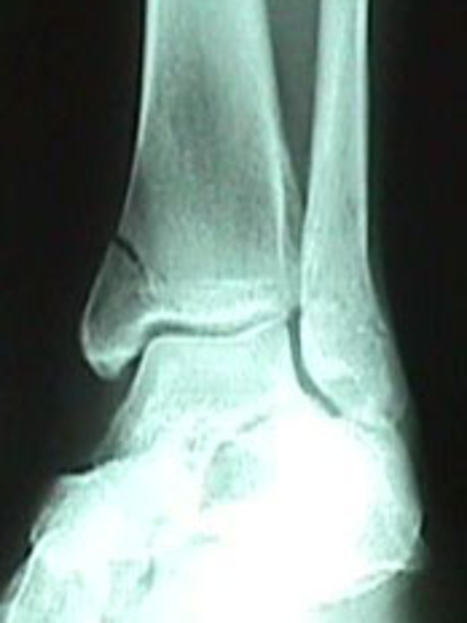 Mortise View of Tibia Fracture