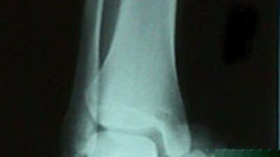 AP View of Ankle Dislocation