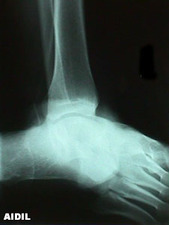 Lateral View of Ankle Dislocation