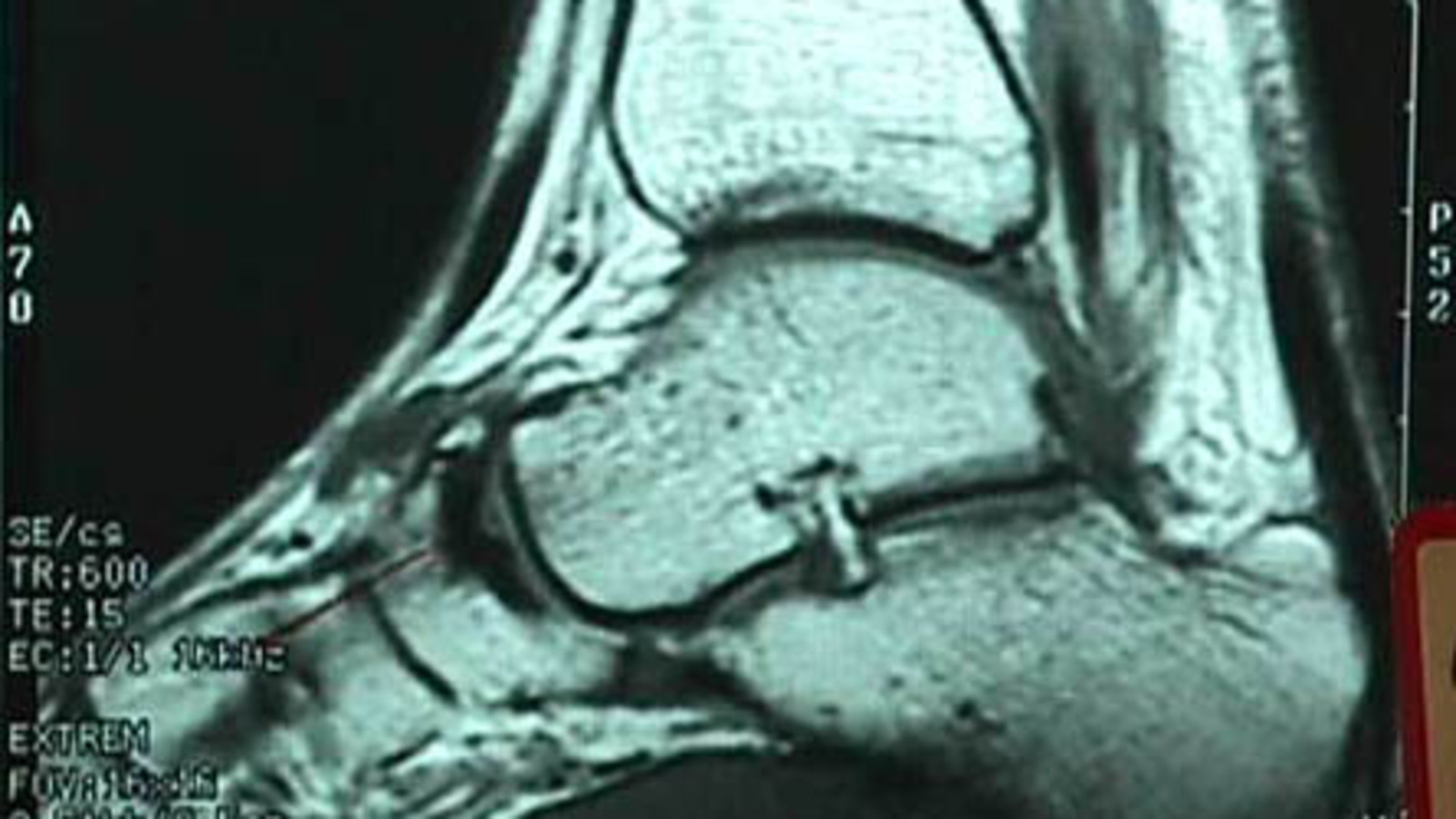 MRI of Osteochondral Defect of Accessory Navicular