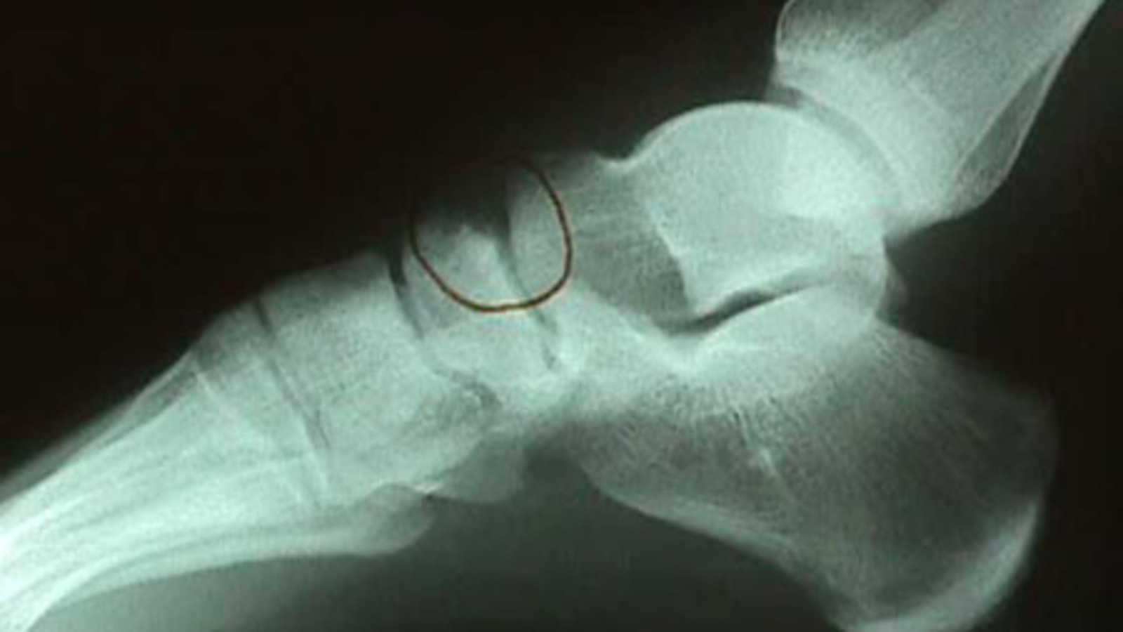 X-Ray of Medial View of Osteochondral Defect of Accessory Navicular