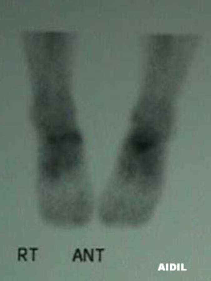 Bone scan of AP View of Osteochondral Defect of Accessory Navicular