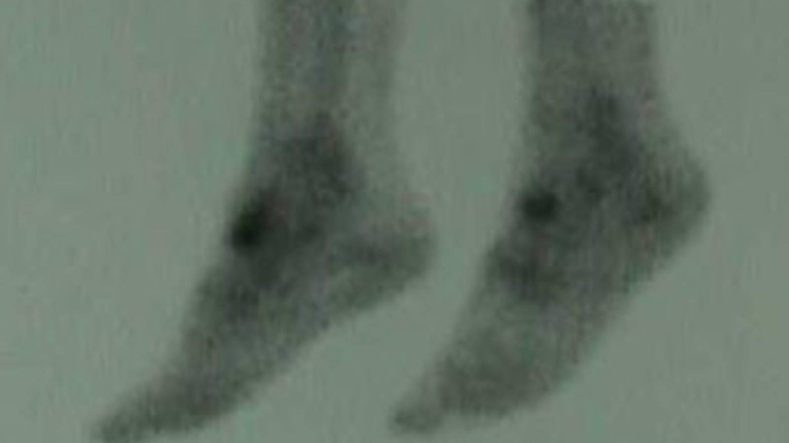 Bone scan of Lateral Left, Medial Right View of Osteochondral Defect of Accessory Navicular