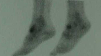 Bone scan of Lateral Left, Medial Right View of Osteochondral Defect of Accessory Navicular