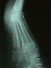 Lateral View of Jones Fracture