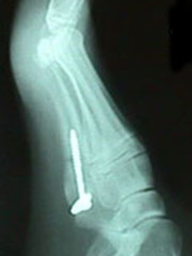 Lateral View of Jones Fracture After Repair