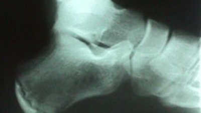 Lateral View of Heel Fracture